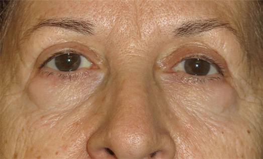 After Botox Treatment