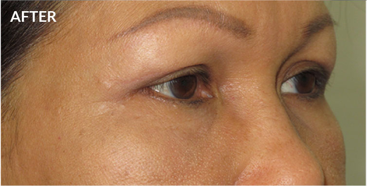 After Lower Blepharoplasty