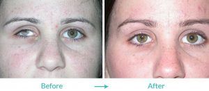 Los Angeles prosthetic eye surgery