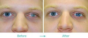 prosthetic eye surgery