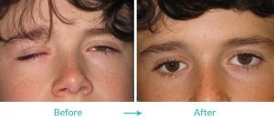 eyesthetica artificial eye surgery