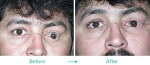 eye socket surgery eyesthetica