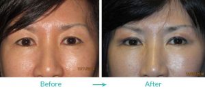 double eyelid surgery in california