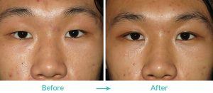 single eyelid to double eyelid procedure Los Angeles