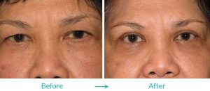 eyesthetica upper asian blepharoplasty