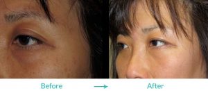 Eyesthetica double eyelid surgery