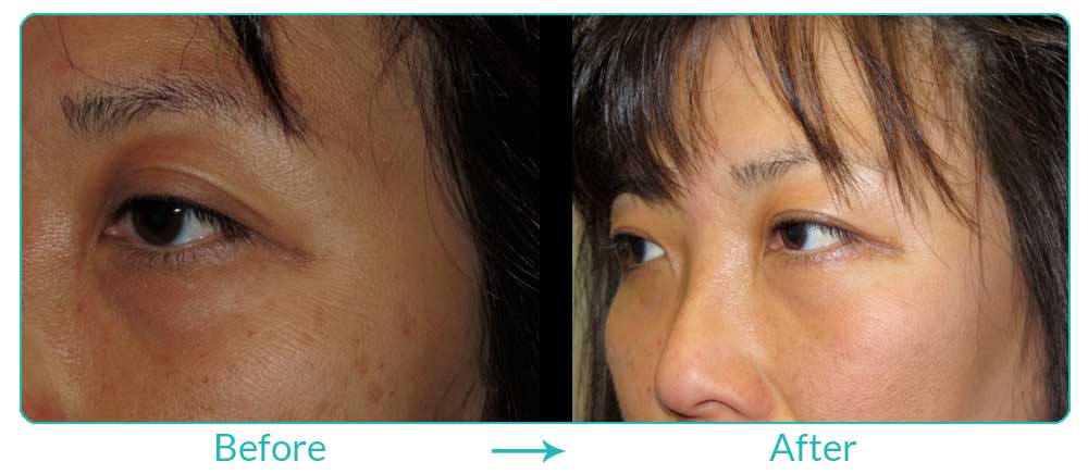 Eyesthetica double eyelid surgery