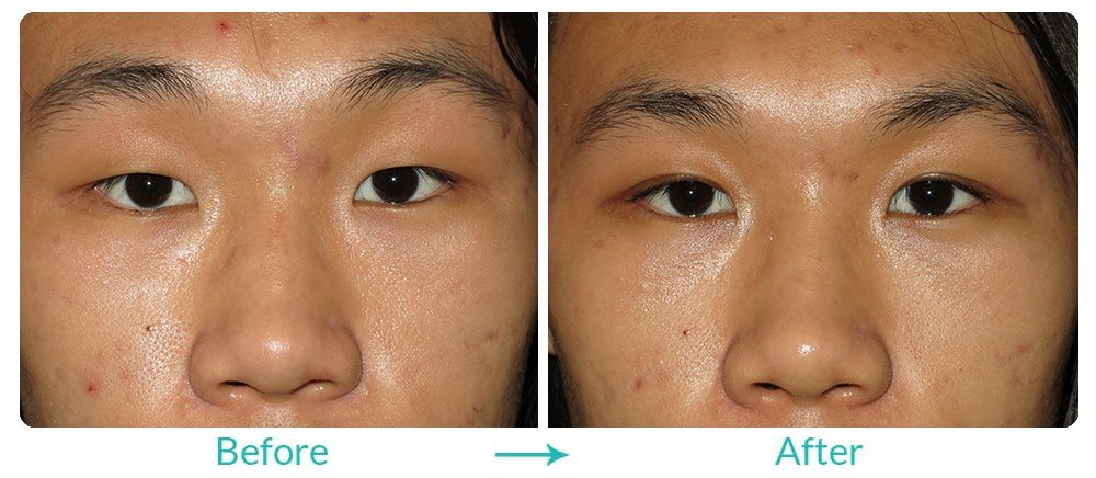 single eyelid to double eyelid procedure Los Angeles