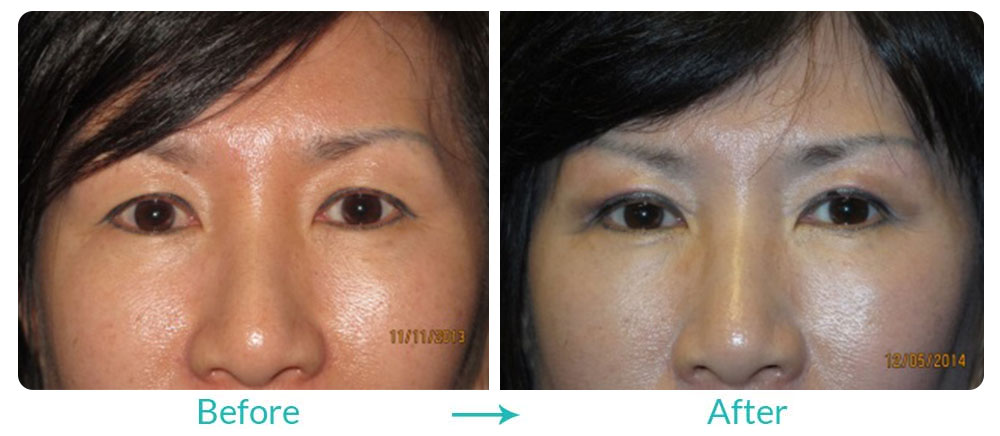 double eyelid surgery in california