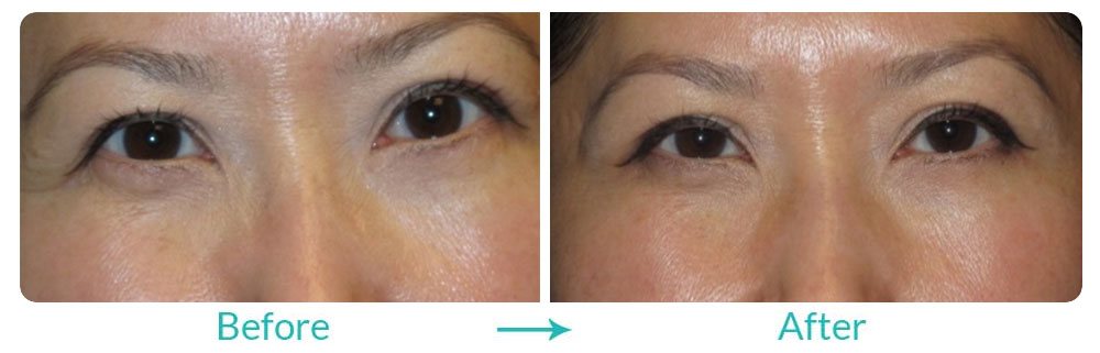 Asian blepharoplasty case-242