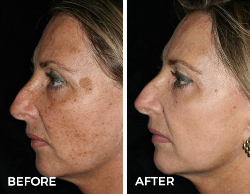 Laser Skin Resurfacing Before and After Results