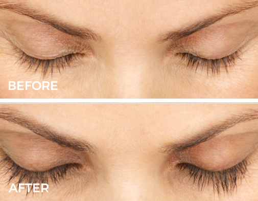 Latisse Eyelashes Before and After Results