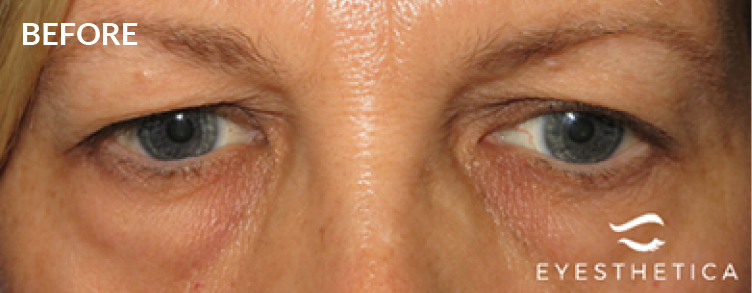 Before Blepharoplasty