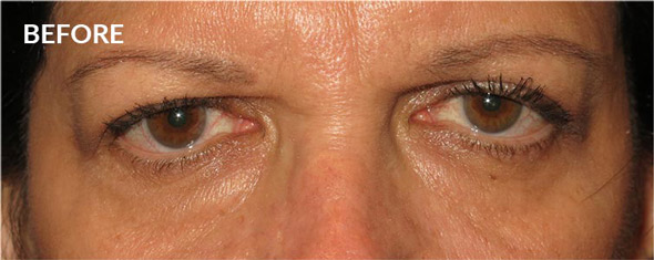 Before Brow Lift Surgery