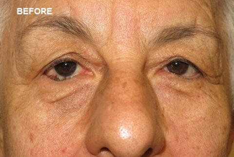Before Entropion Surgery
