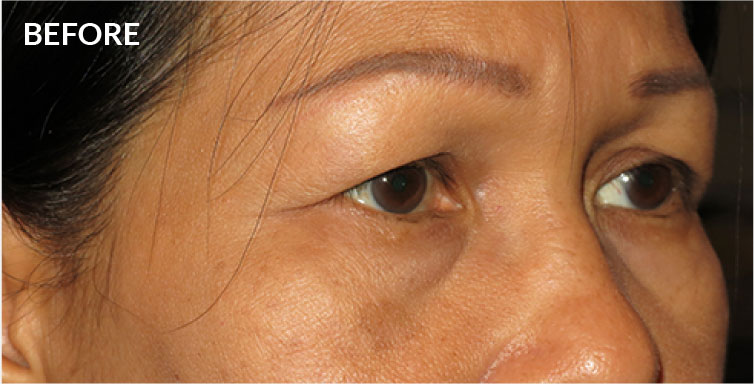 Before Lower Blepharoplasty