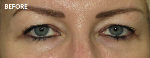 Before Upper Blepharoplasty