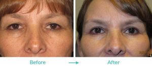 multiple eyelid deformation treatment