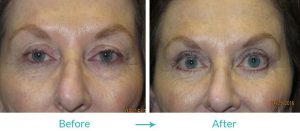 ptosis and blepharoplasty surgery