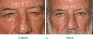 Upper and Lower Blepharoplasty Repair