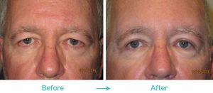best eyelid lift procedure for men