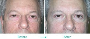 top blepharoplasty surgery los angeles