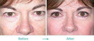 excessive skin surgery procedure in eyesthetica