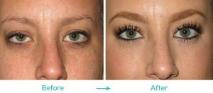 eyesthetica blepharoplasty procedure