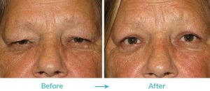 best upper blepharoplasty surgery in Los Angeles