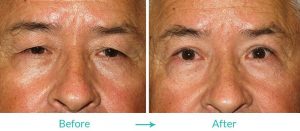 excessive skin surgery