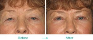 upper eyelid excessive skin treatment