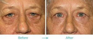 blepharoplasty treatment for upper and lower eyedlids
