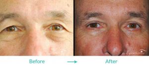upper eyelid lift