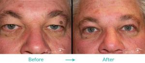 eyelid lift