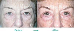 eyelid lift and under eye bags procedure