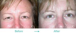 Eyesthetica eyelid lift case 011