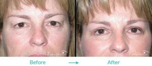 eyelid lift-case-010