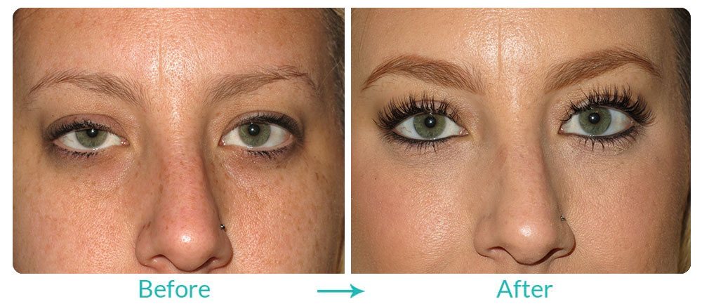 eyesthetica blepharoplasty procedure