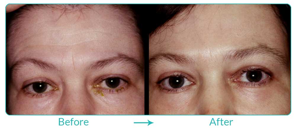 brow lift and laser treatment for los angeles patients