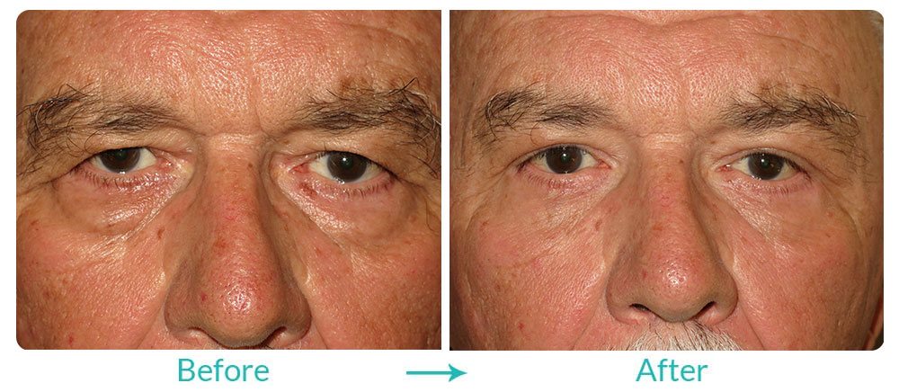 Case 140 blepharoplasty procedure california