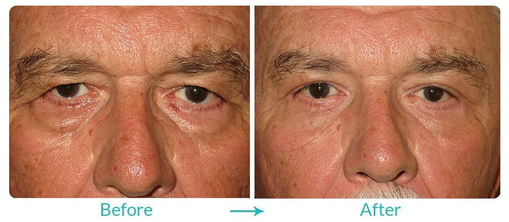 blepharoplasty procedure california