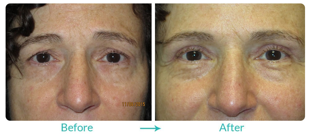 brow lift and upper blepharoplasty double procedure