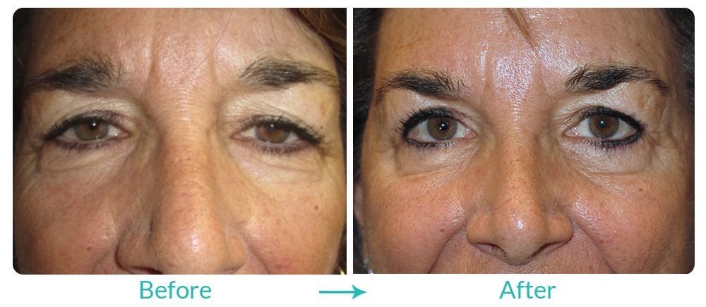 Brow lift and upper lower blepharoplasty case-125