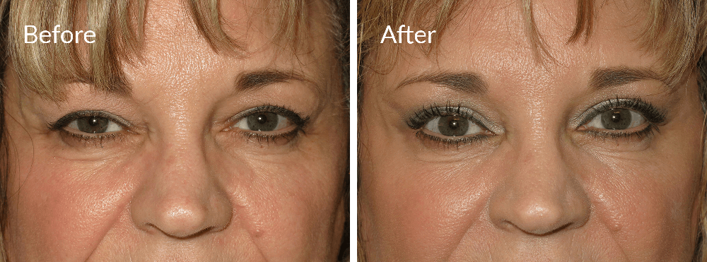 Brow Lift