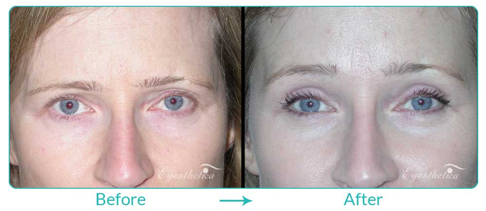 eyesthetica brow lift