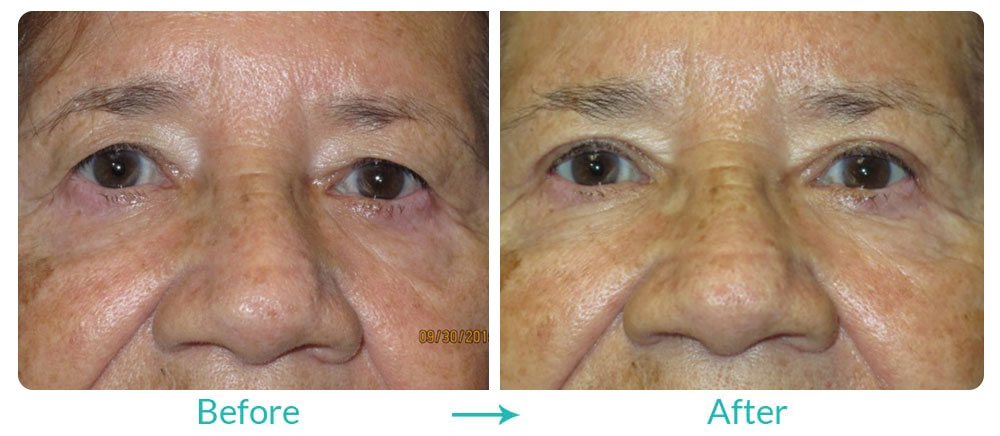 eyesthetica the best brow lift repair doctors