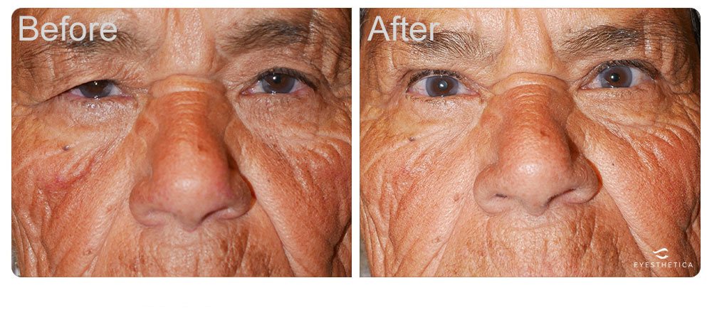 brow lift for Los Angeles patients