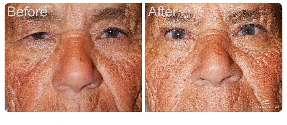 Case 259 brow lift for Los Angeles patients