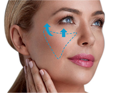 Cheek facelift illustration