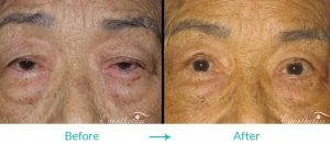 upper eyelid surgery